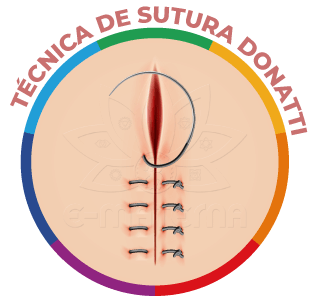 Imagem de um ponto Donatti em pele.